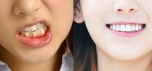 給你看看12張KPOP IDOL過去​的牙齒並不總是完美的照片